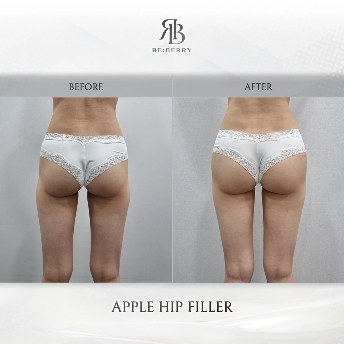 Hip up filler before and after showing rounder buttock profile at RE:BERRY Incheon Airport Korea