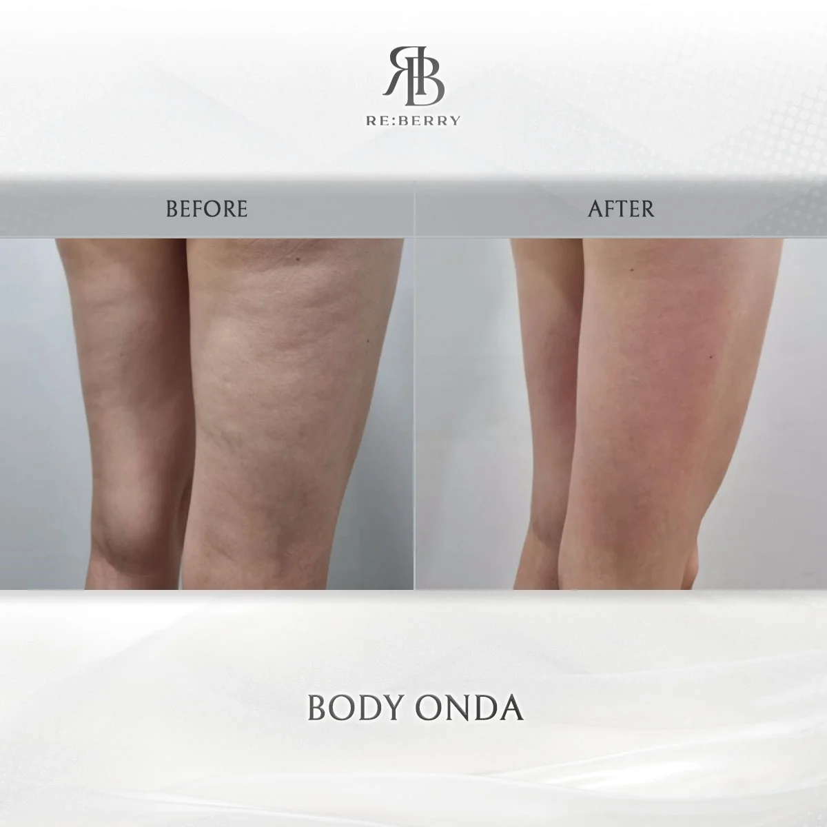 Onda Coolwaves body contouring before and after at RE:BERRY Incheon Airport