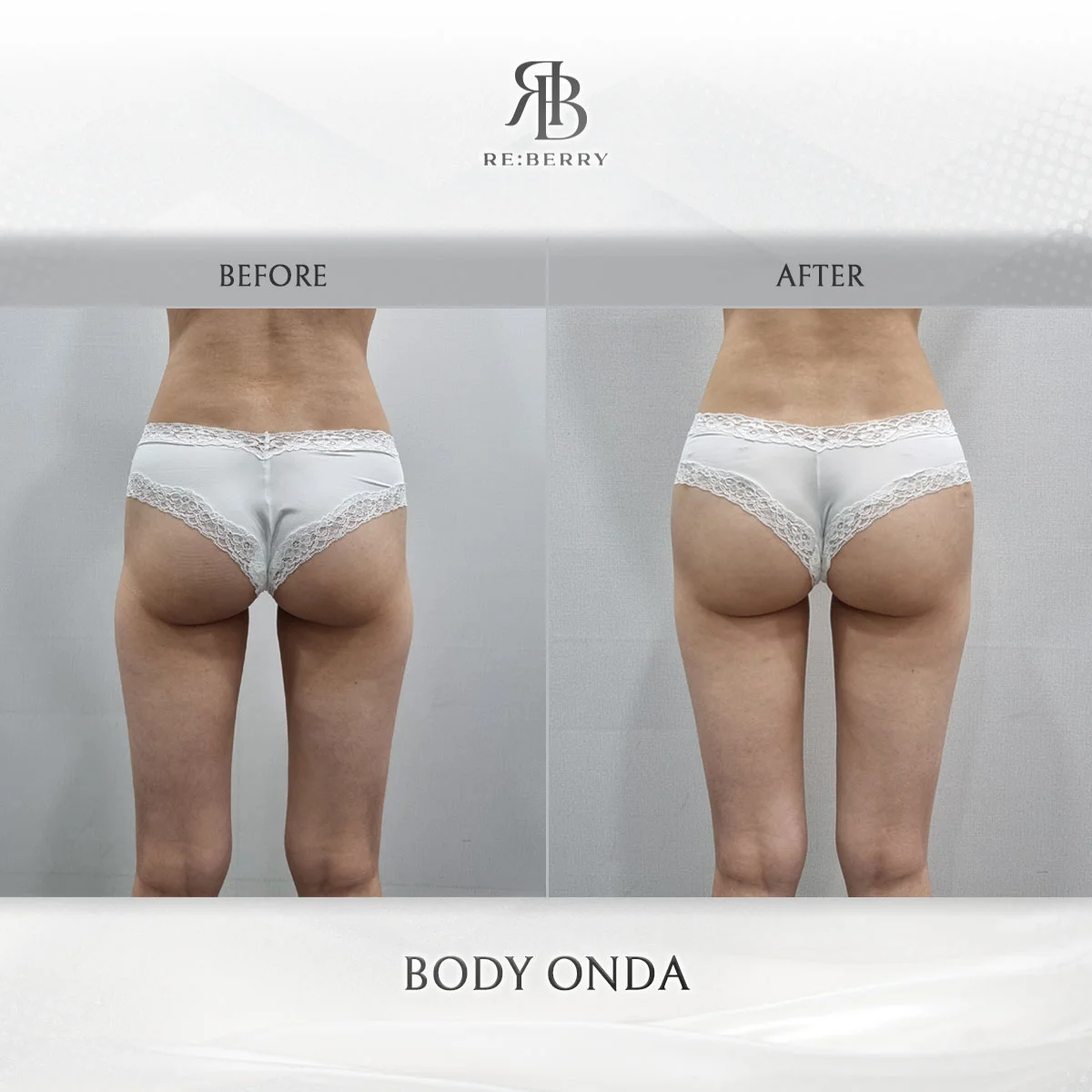 Body sculpting Onda before and after flanks result at RE:BERRY