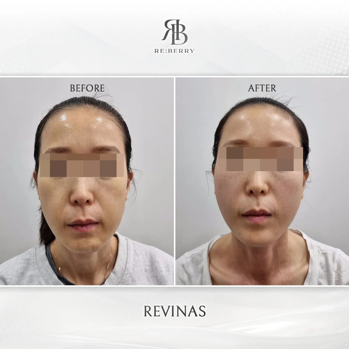 Before and after lifting treatment result at RE:BERRY Clinic Incheon Airport Seoul — real patient photo