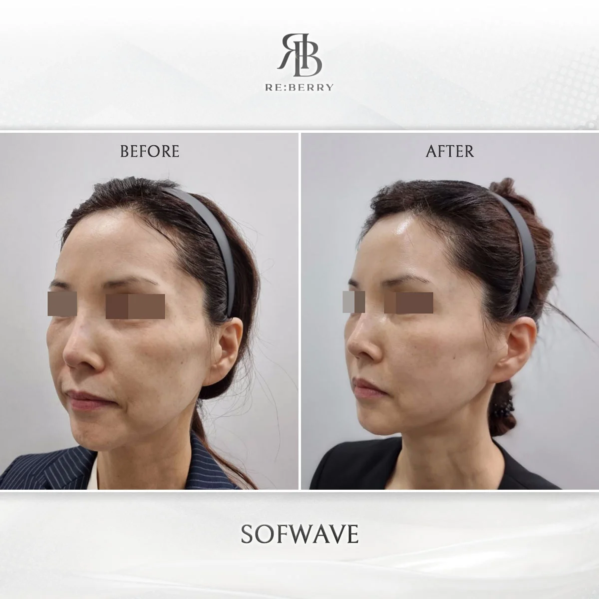 Sofwave mid-face lifting at RE:BERRY Incheon Airport Korea
