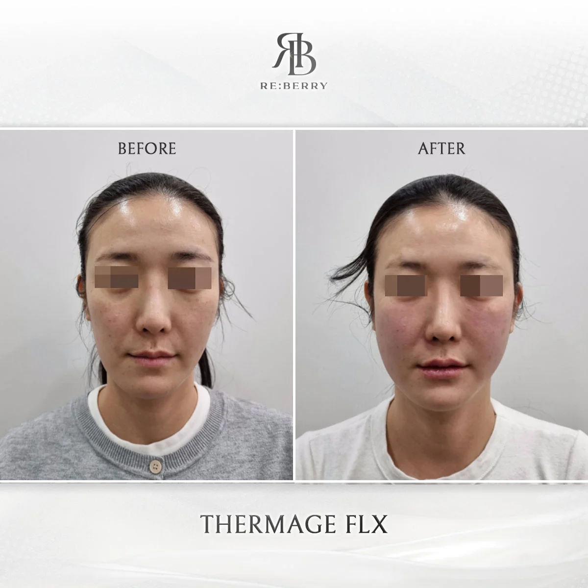 Thermage FLX combined with HIFU before and after results at RE:BERRY Incheon Airport Korea