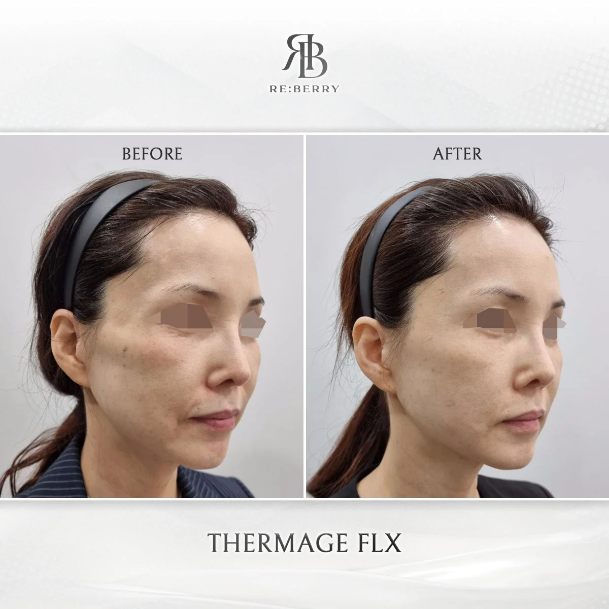 Thermage mid face tightening nasolabial fold improvement before and after RE:BERRY Incheon clinic