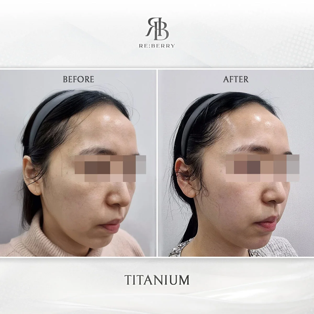Soprano Titanium skin texture improvement before after photo