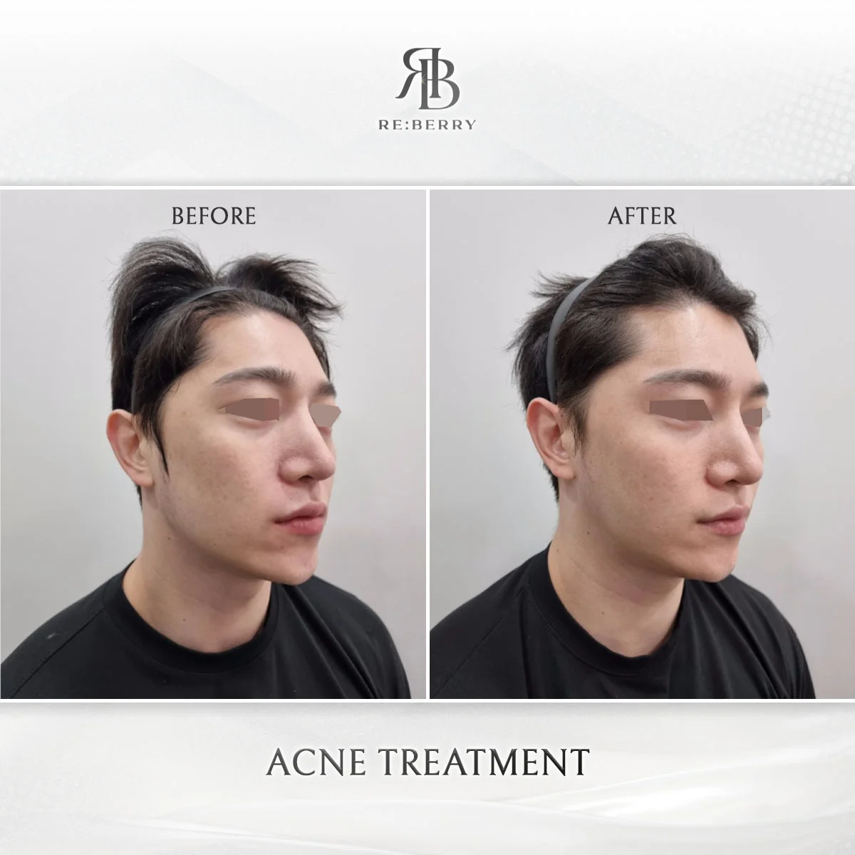 Acne treatment before and after close-up at RE:BERRY Incheon Airport Korea — real patient photo 2