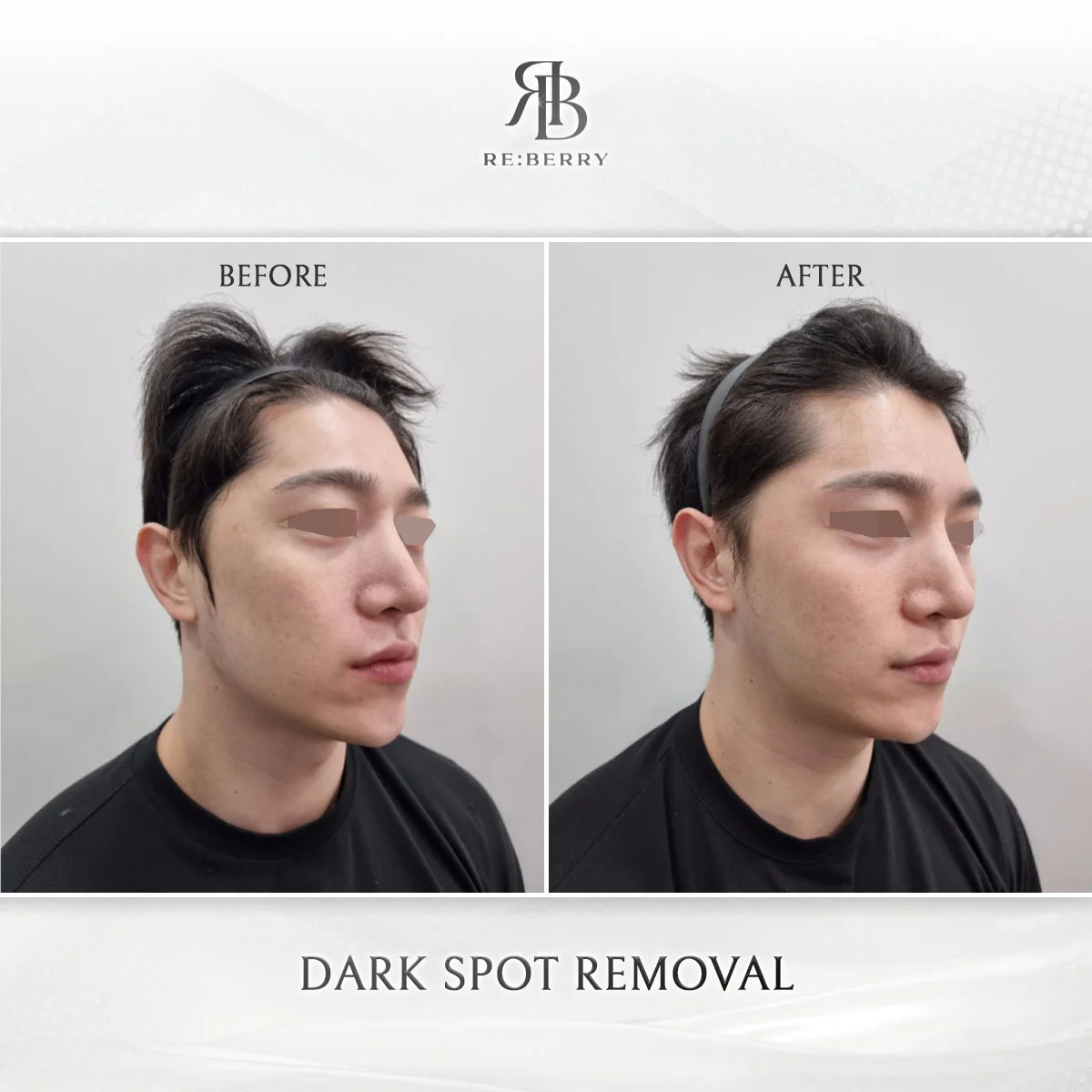 Cheek melasma before after laser toning Seoul Korea