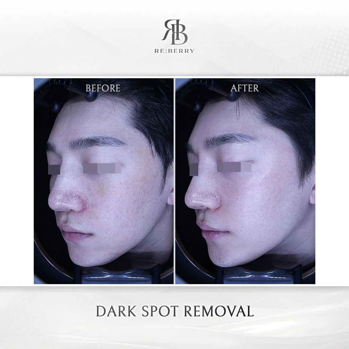Laser toning treatment in progress at RE:BERRY Incheon Airport