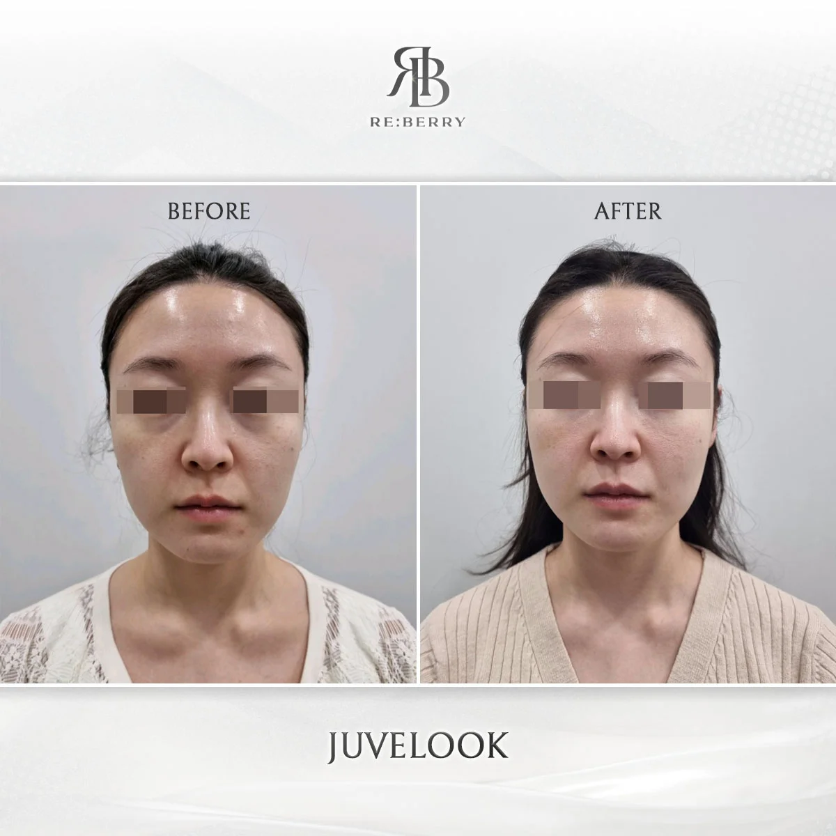 Rejuran skin booster Korea before after pore improvement