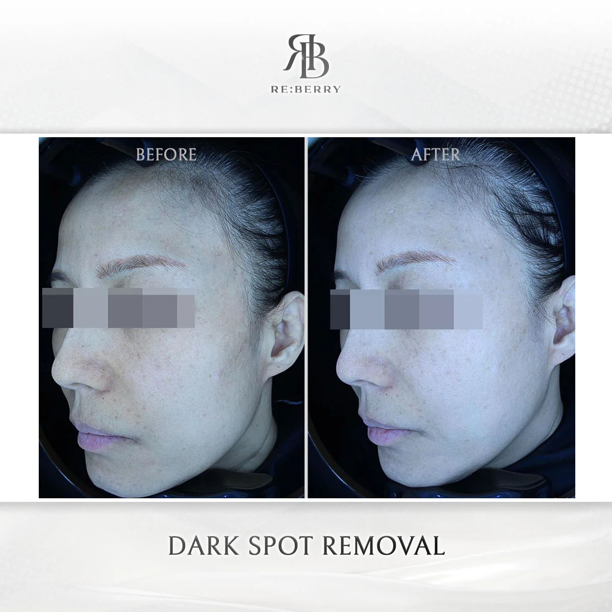 Dark spot removal before and after showing significant clearing of facial hyperpigmentation with PicoSure laser
