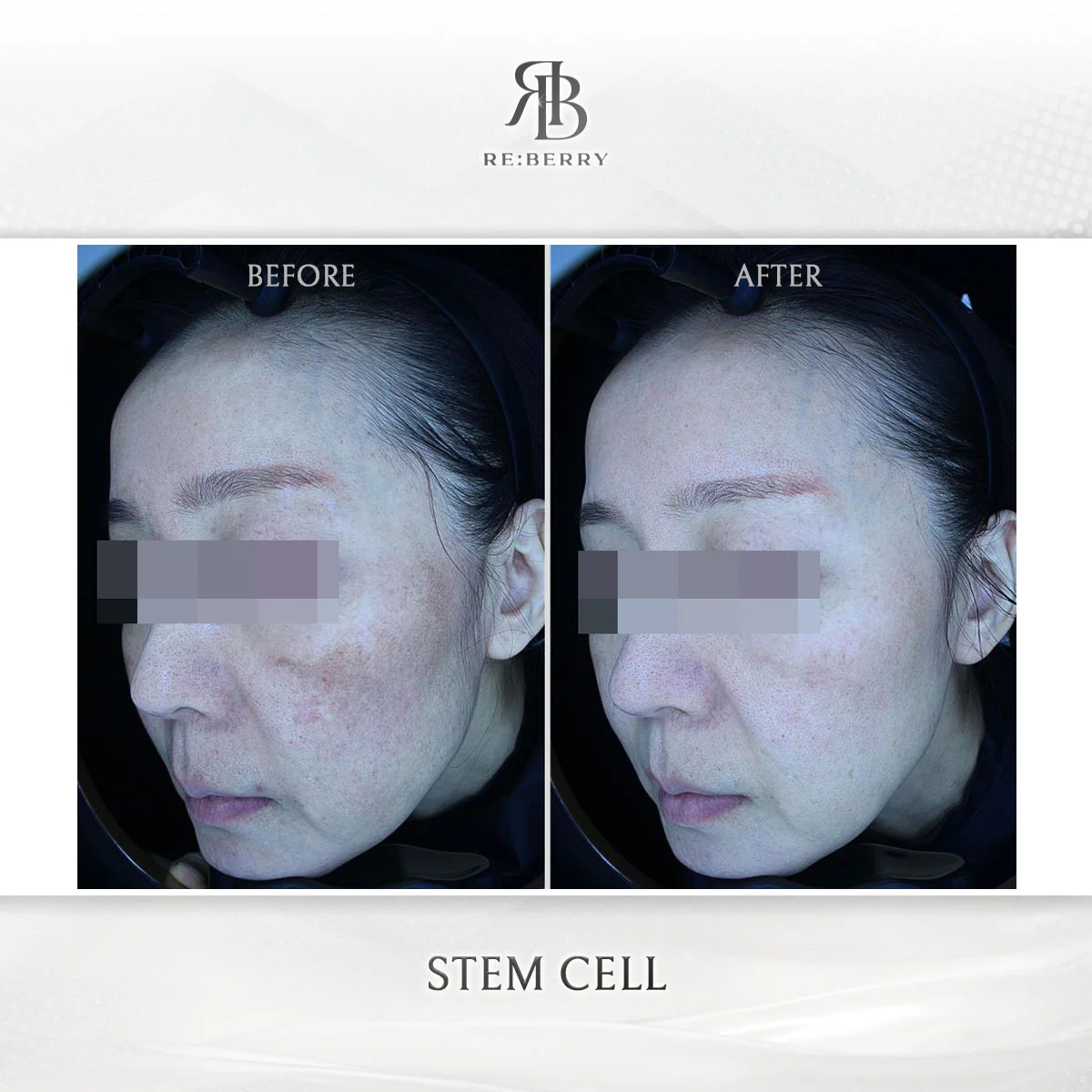 PRP therapy anti-aging result before after at RE:BERRY clinic Korea