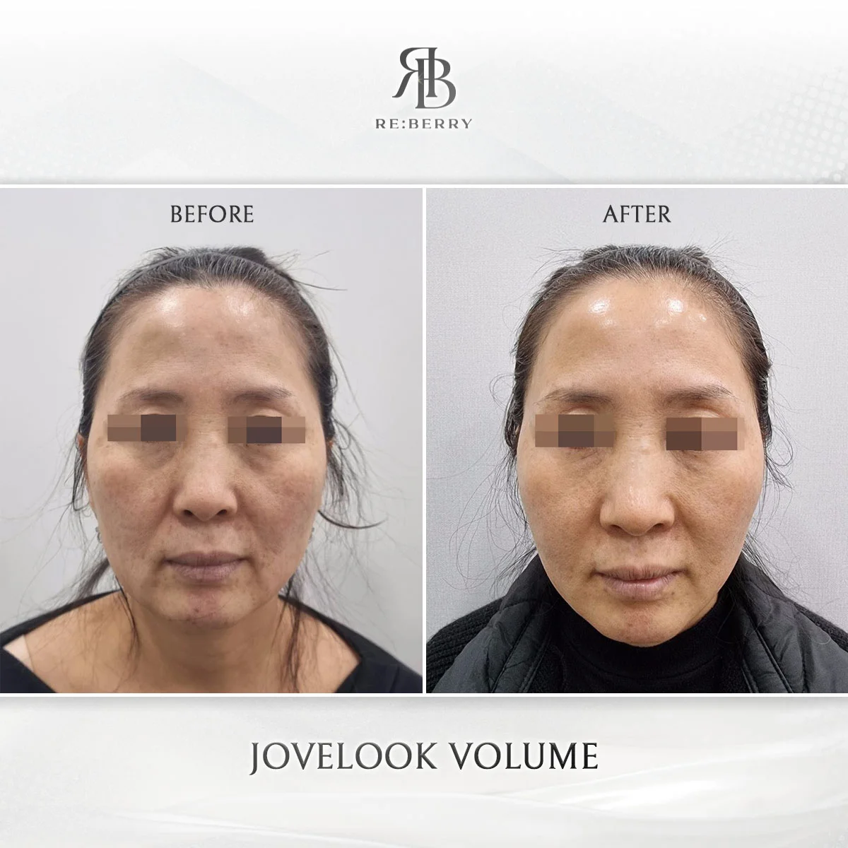 Dermal filler volume restoration before and after clinical result at RE:BERRY