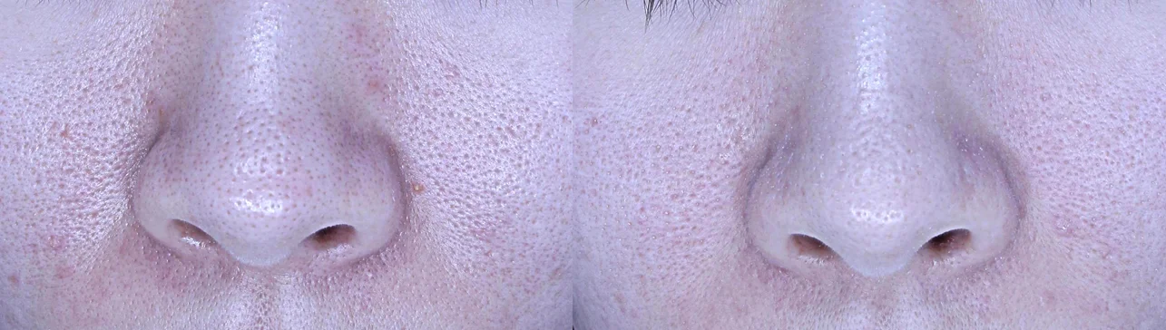 아리엘의원 쥬베룩 시술 전후 비교