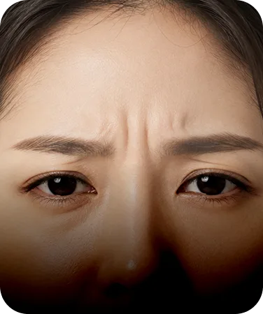미간 주름 자연스러운 개선