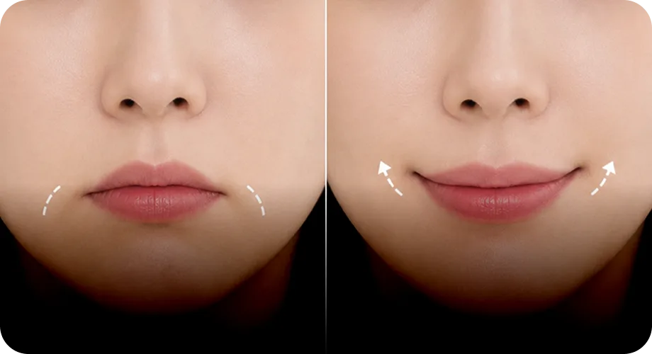 처진 입꼬리 즉각 보강