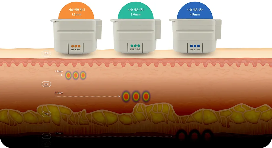 SMAS 근막층 정밀 타격