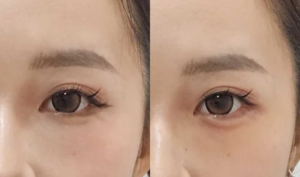 애교필러 전후 — 명동점