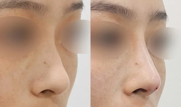 엘스코 2줄 + 쥬비덤 코필러 1CC 전후 — 명동점