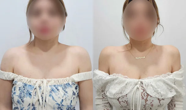 어깨필러 전후 — 명동점