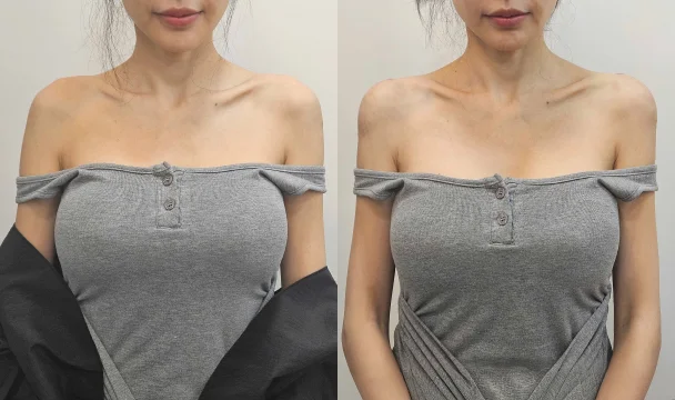 어깨필러 전후 — 명동점