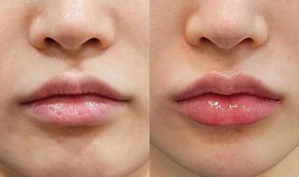 입술필러 전후 — 명동점
