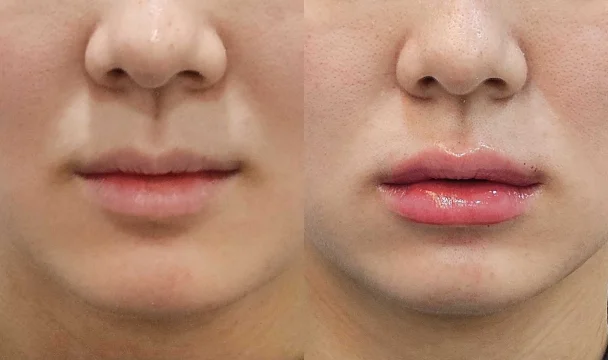 입술필러 전후 — 명동점