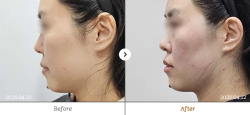소프웨이브 전후 — 명동점 백승재원장