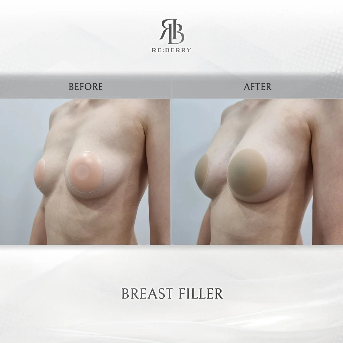 Breast filler before and after — patient 3
