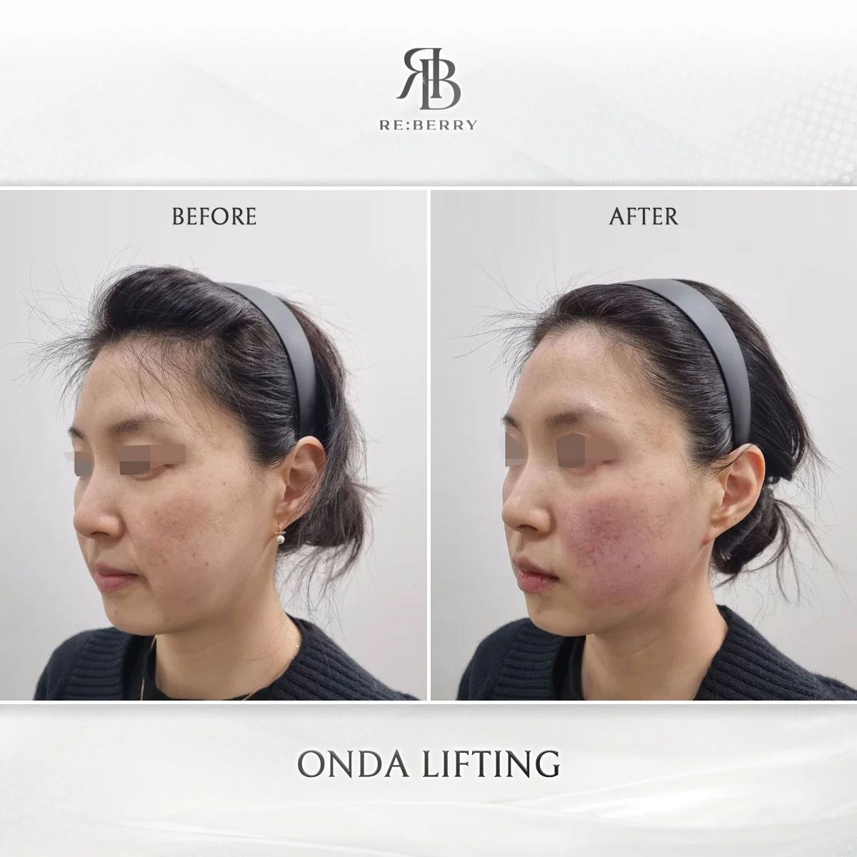 Onda lifting collagen remodeling before after result