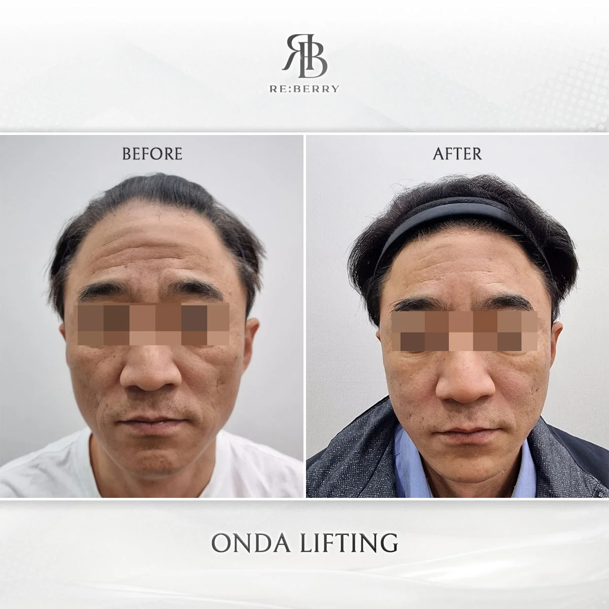 Onda Coolwaves skin tightening before after comparison