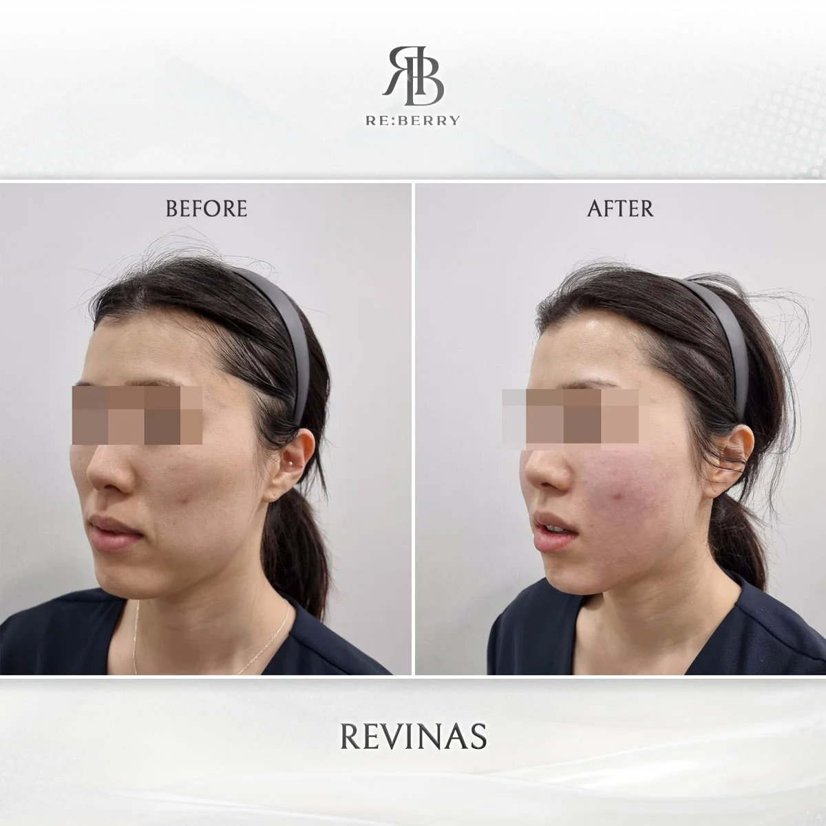 Skin tightening RF treatment before after showing nasolabial fold improvement at RE:BERRY Myeongdong