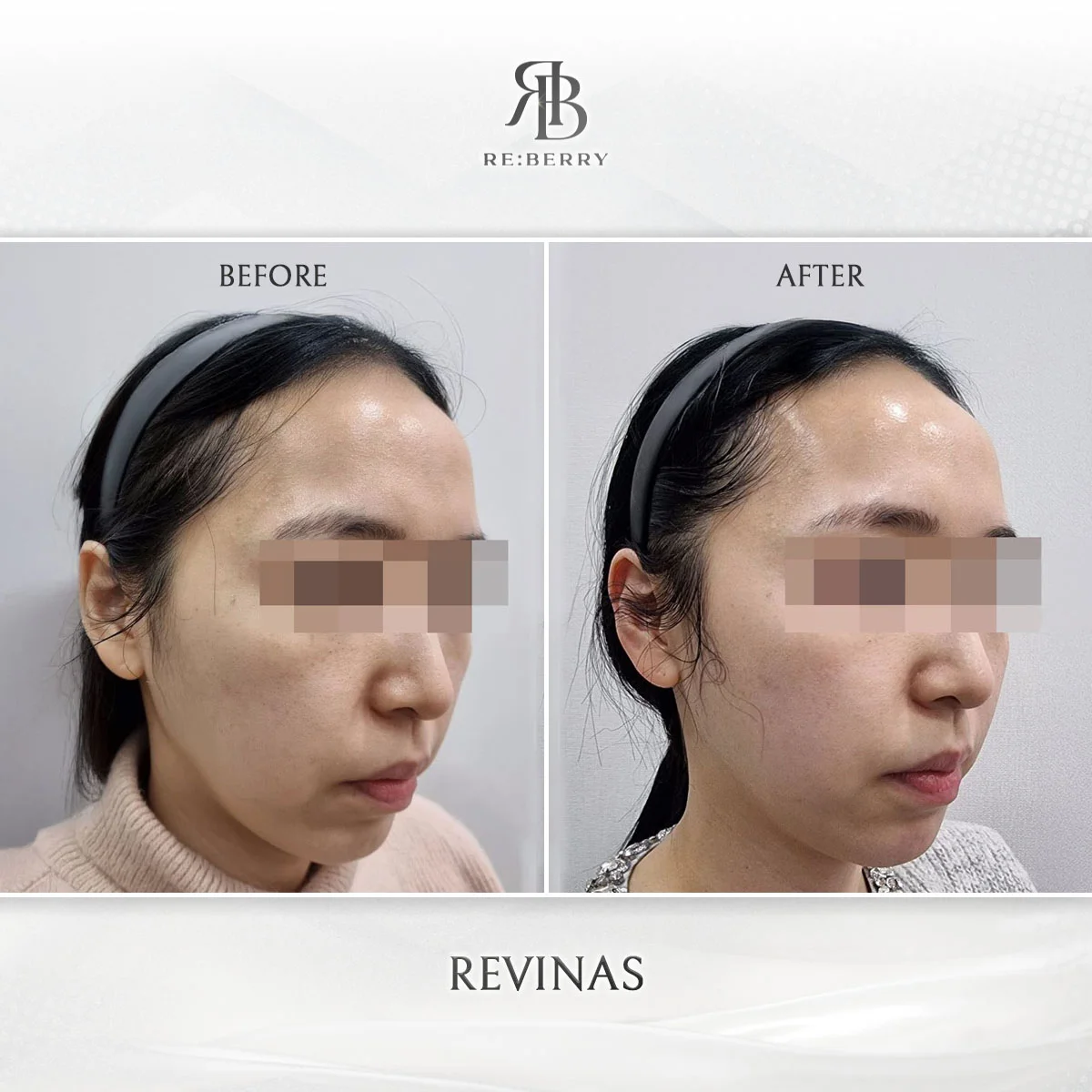 Lower face V-line contouring before and after with thread lift Seoul Korea