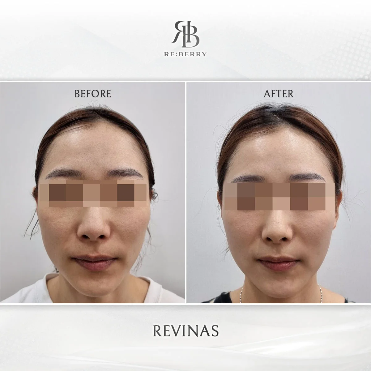 Jowl lifting and V-line definition before after comparison RE:BERRY Myeongdong