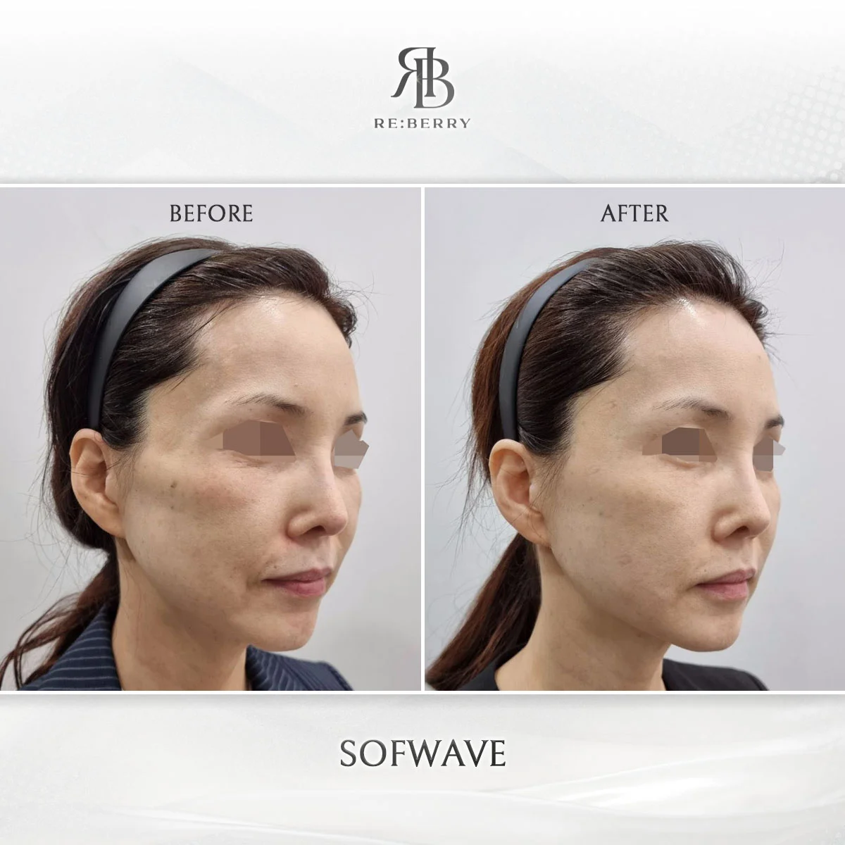 Sofwave anti-aging result case 13 at RE:BERRY Myeongdong