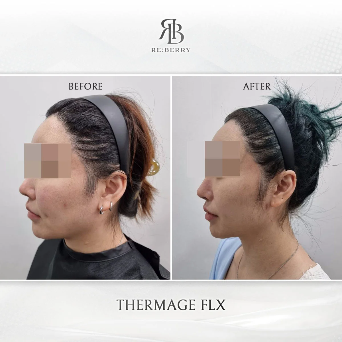 Thermage FLX jawline tightening before after result at RE:BERRY Myeongdong