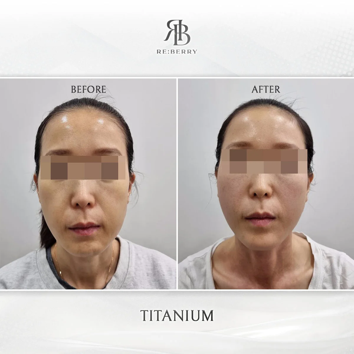 Before and after lifting treatment result at RE:BERRY Clinic Myeongdong Seoul — real patient photo