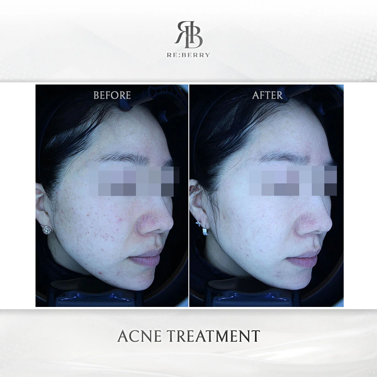 Active acne clearance result after Potenza RF and laser treatment at RE:BERRY Myeongdong