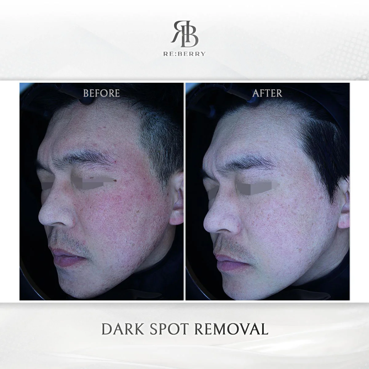 Dark spot removal before and after — patient 9
