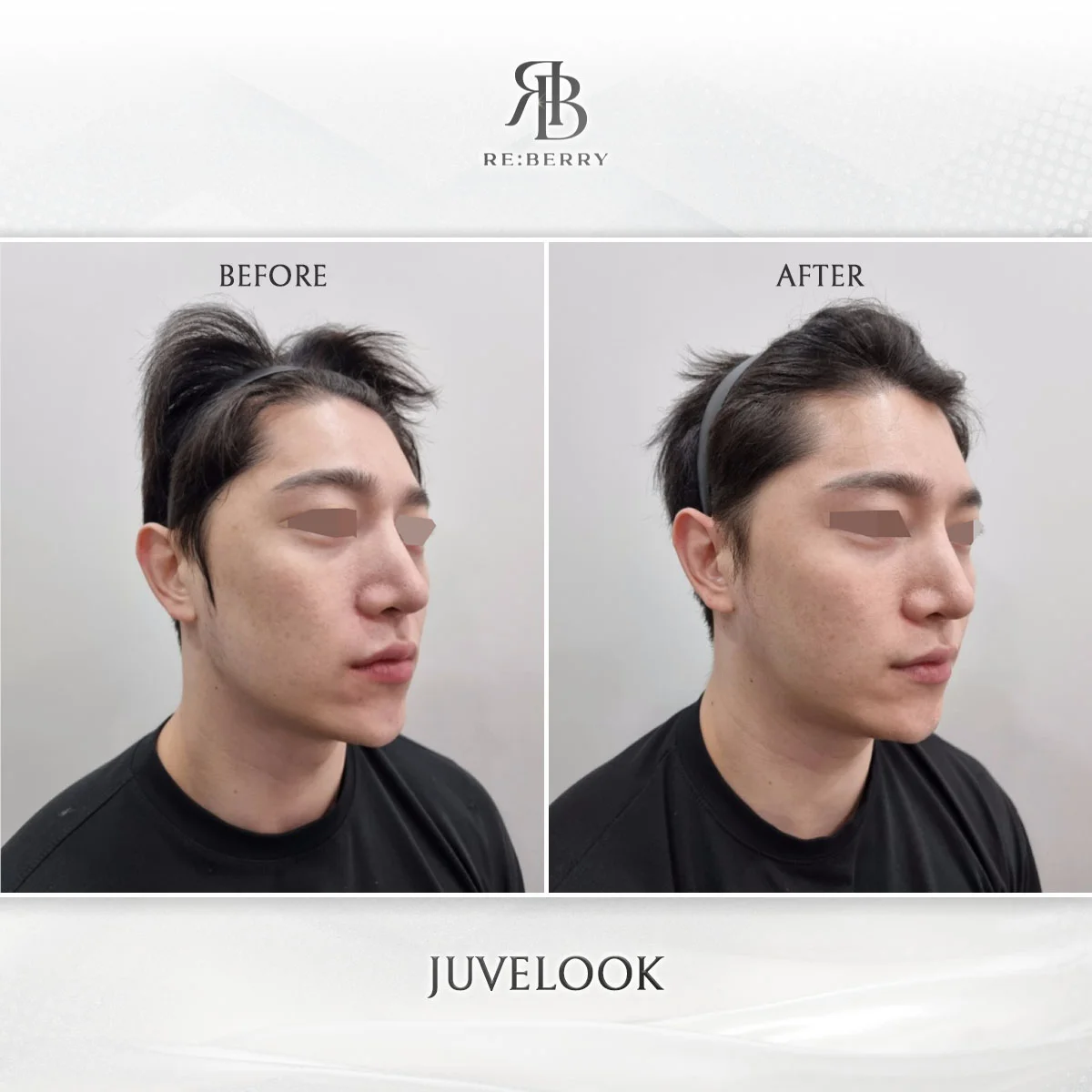 Before and after LDM Water Drop Lifting treatment at Myeongdong skin clinic