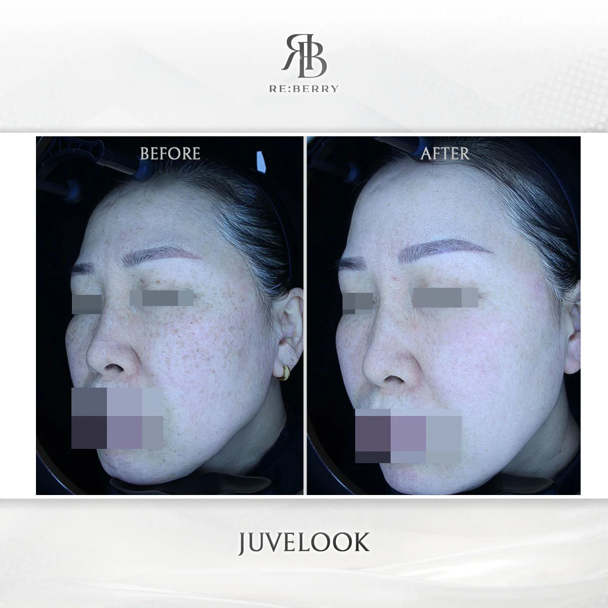 Juvelook skin brightening before and after