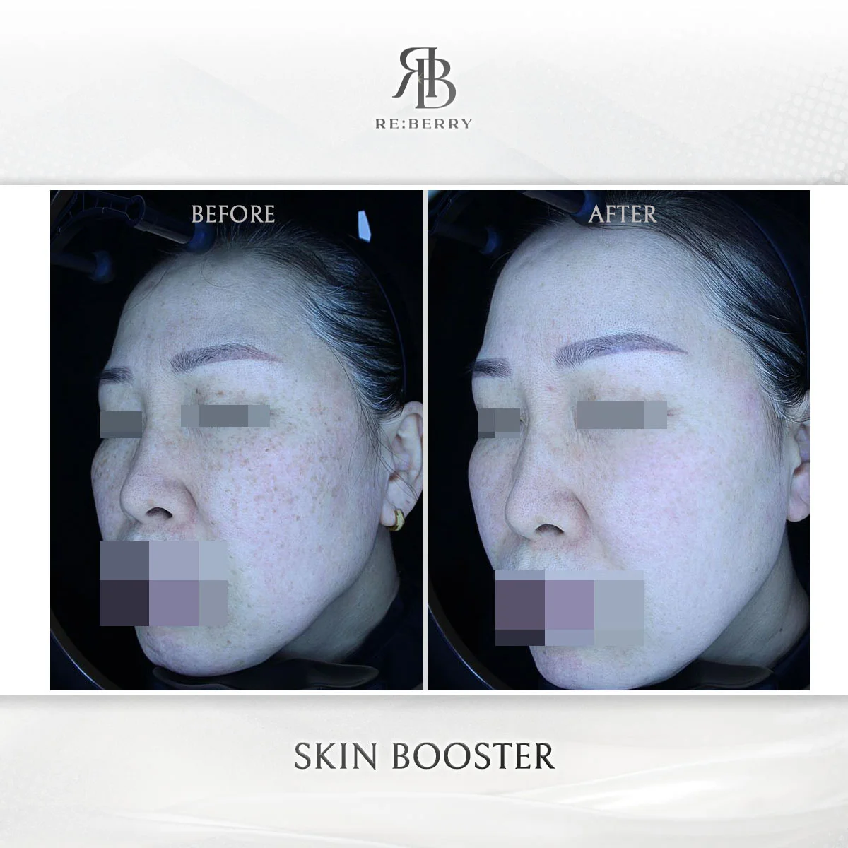 Before and after forehead wrinkle treatment with skin booster at RE:BERRY Myeongdong Seoul