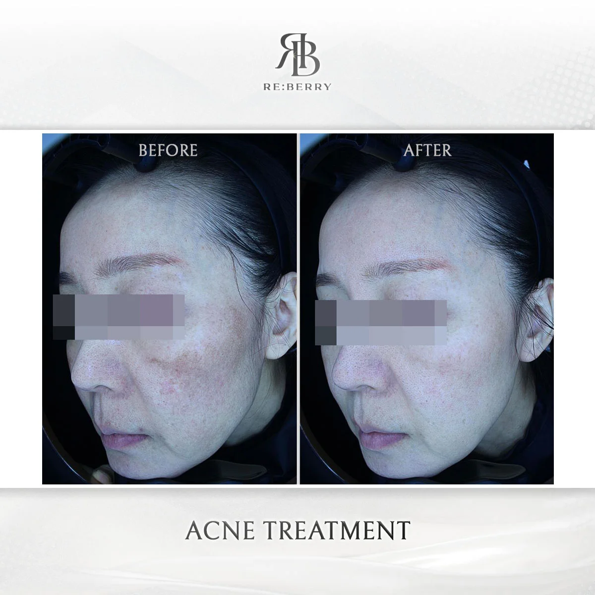 Active acne treatment before and after showing dramatic clearing of inflammatory acne lesions