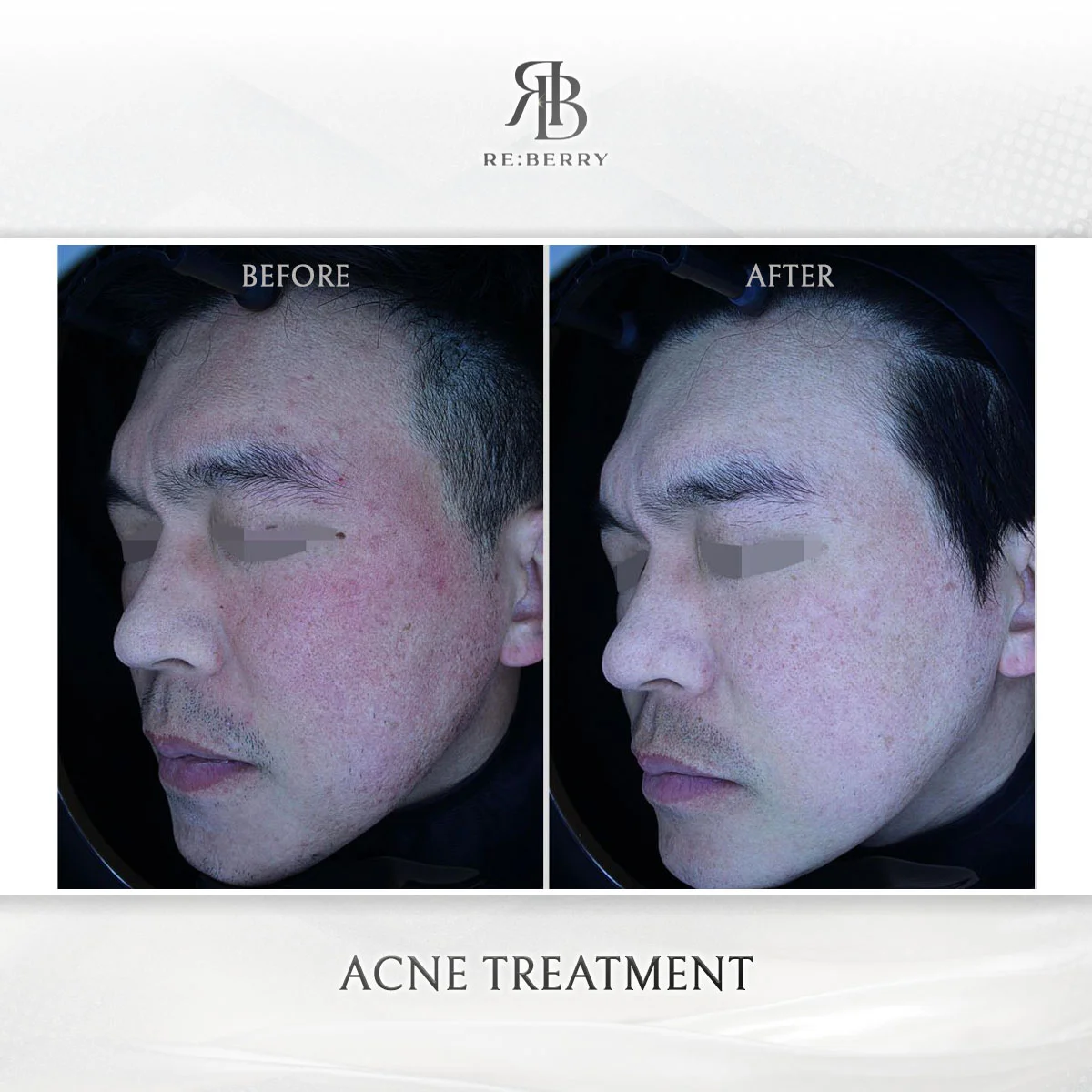 Laser acne treatment showing progressive clearing of papulopustular acne over treatment series