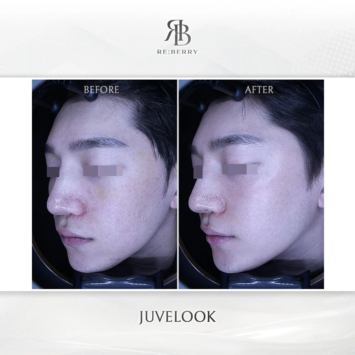 Juvelook collagen stimulation before and after showing skin tightening effect