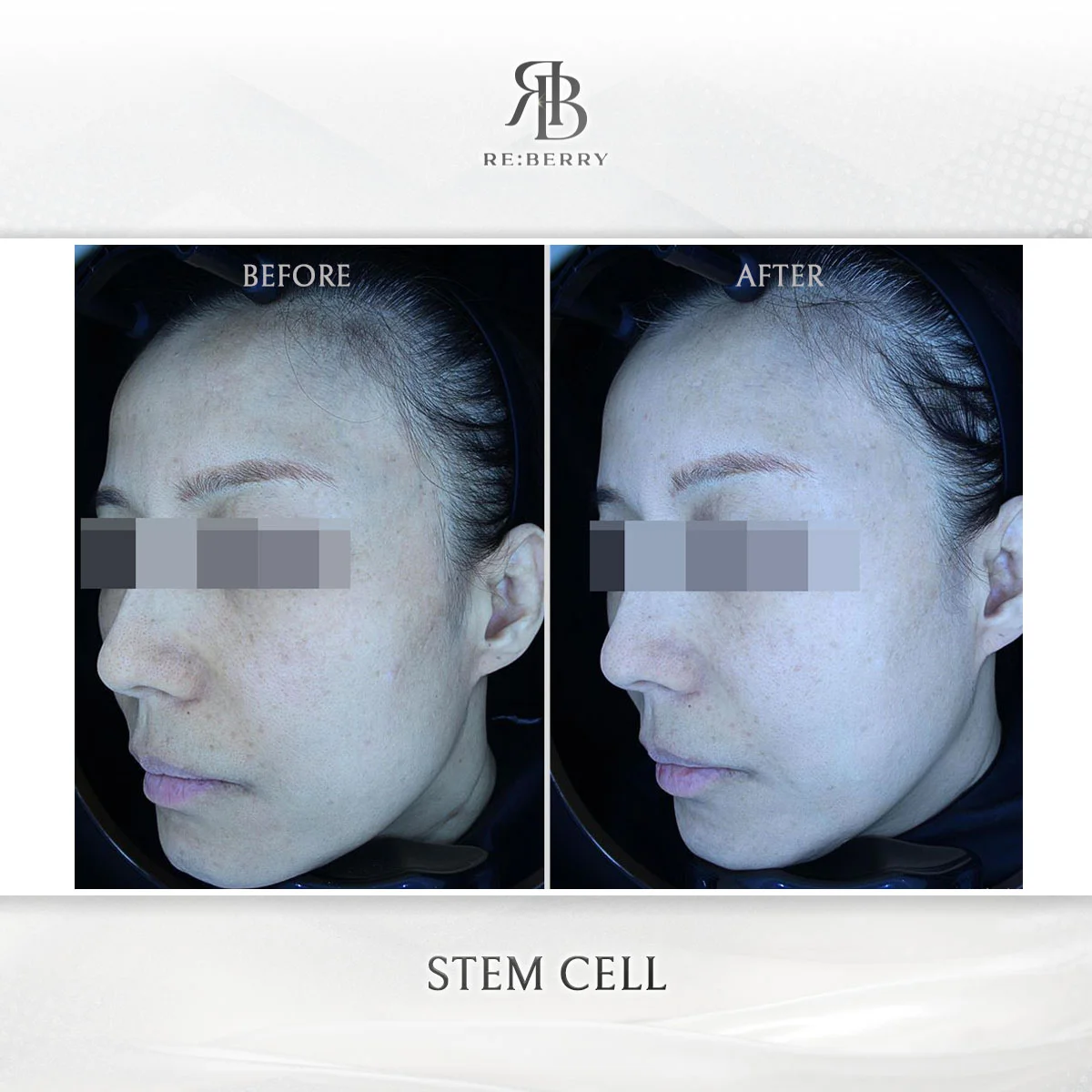 Stem cell facial rejuvenation before and after at RE:BERRY Myeongdong