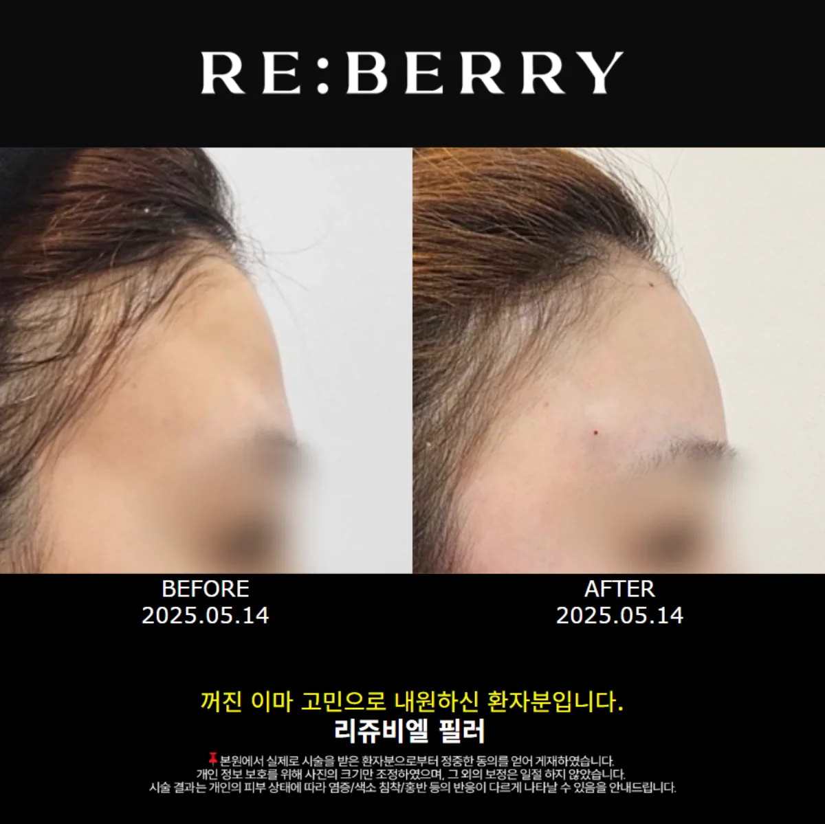 Before and after forehead filler treatment showing smooth contour at RE:BERRY Myeongdong