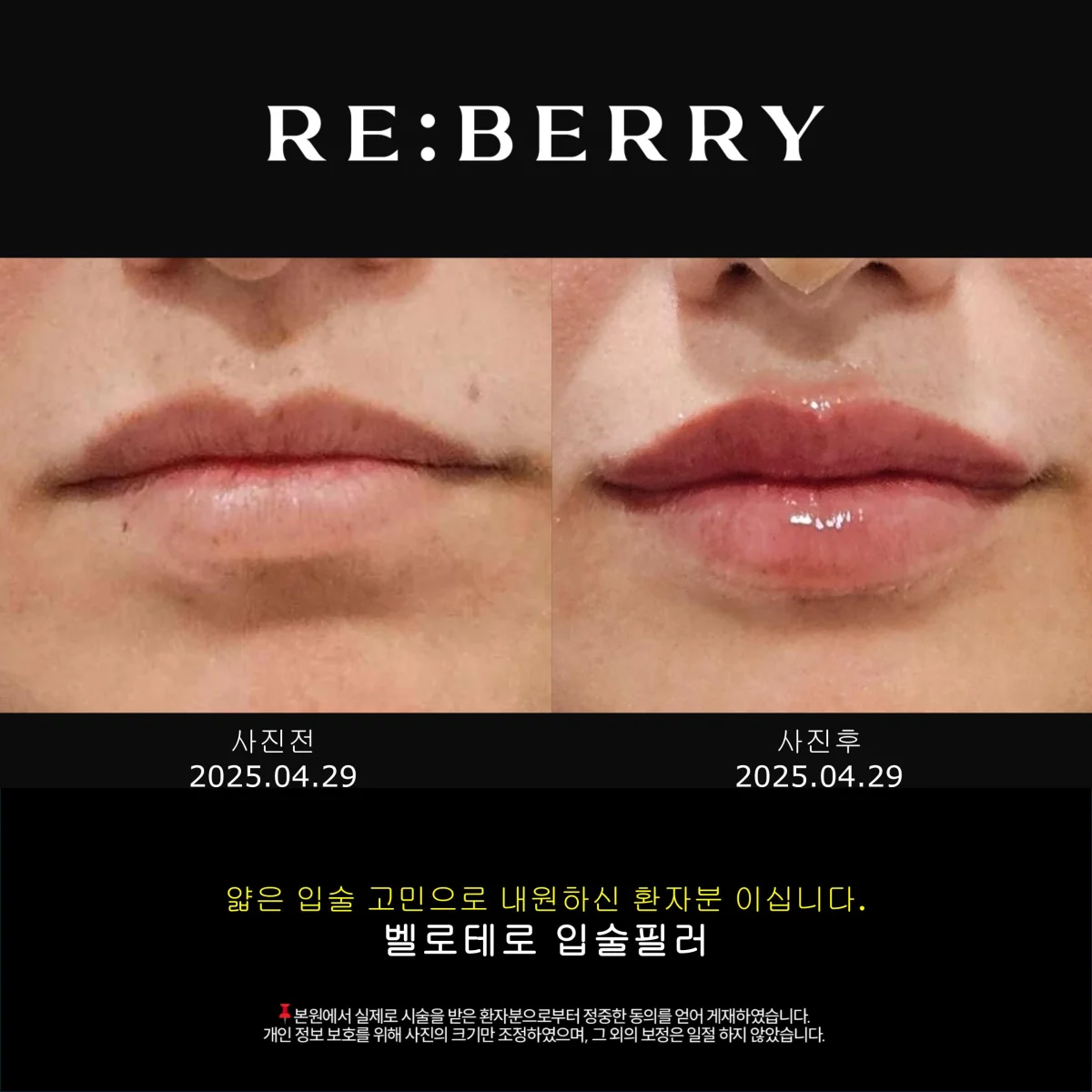 Before and after lip filler treatment showing balanced lip symmetry at RE:BERRY Myeongdong