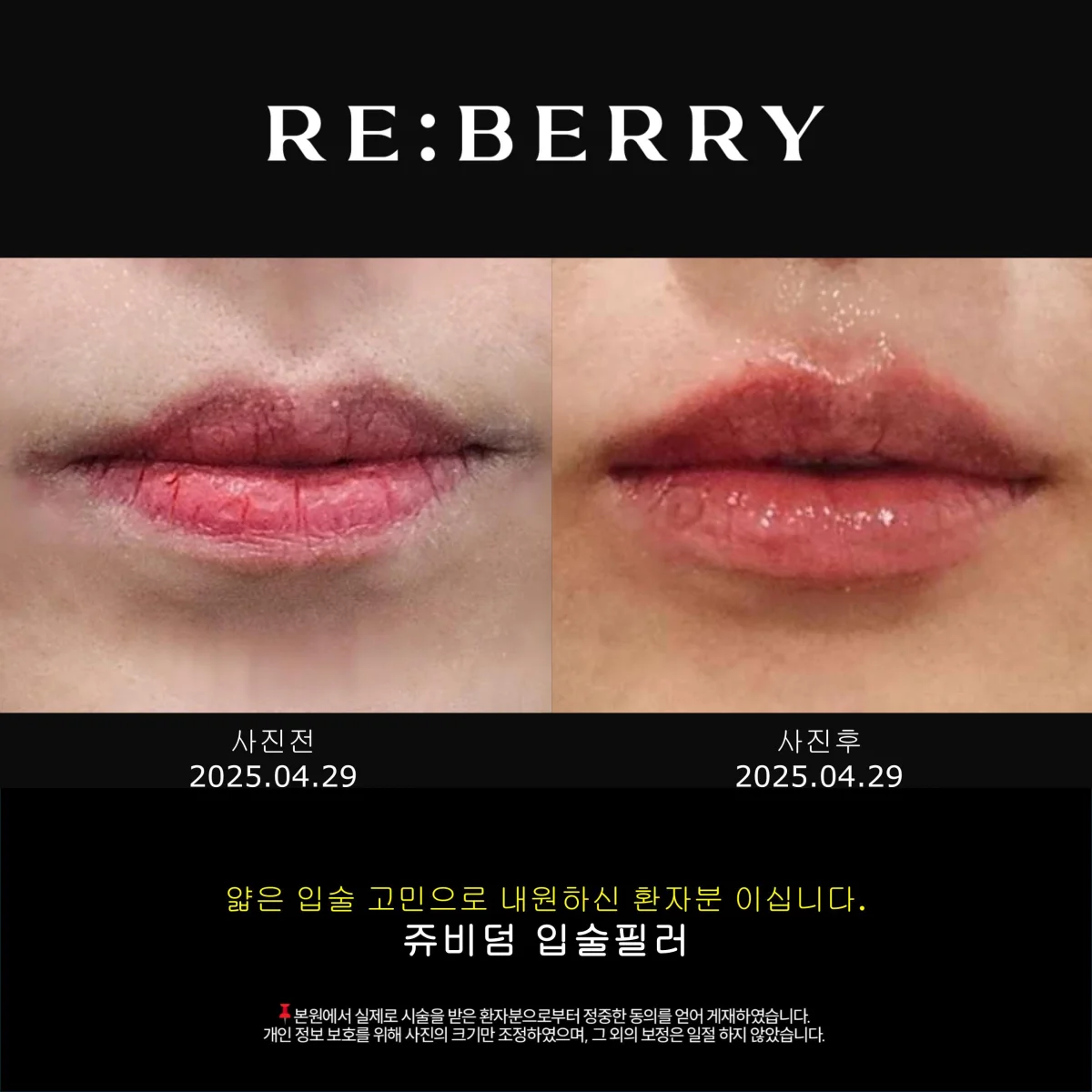 Before and after Juvederm lip filler showing natural volume enhancement at RE:BERRY Myeongdong Seoul