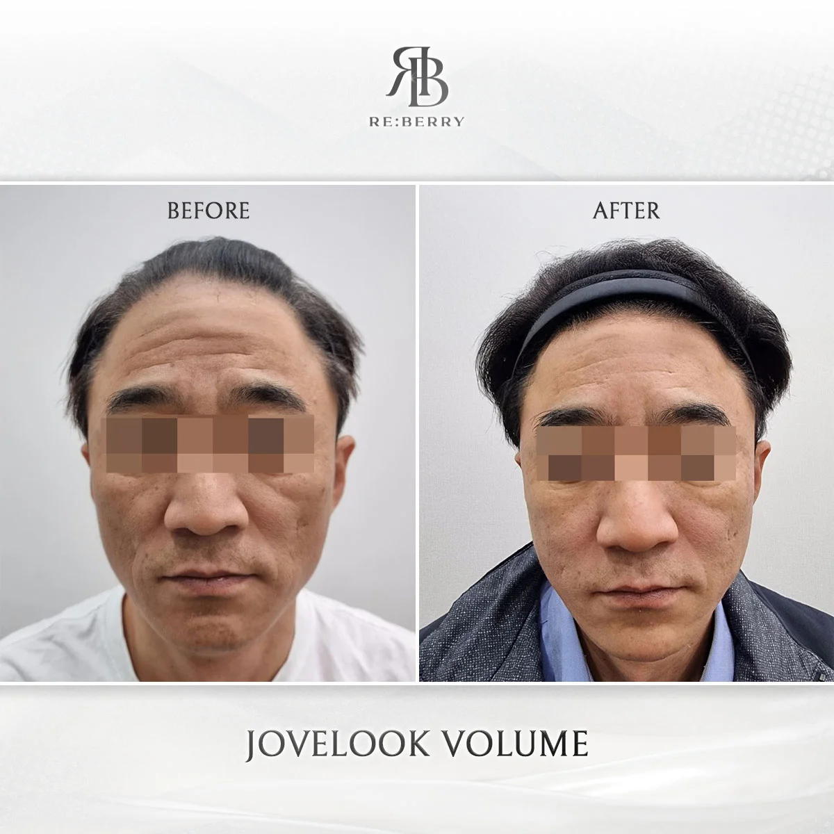 Filler correction and natural restoration result