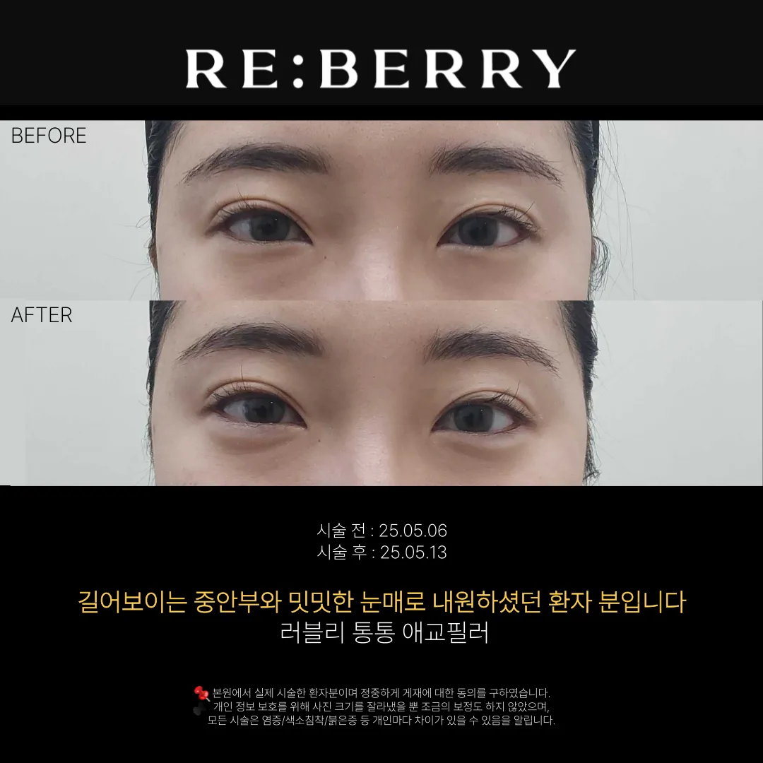 애교필러 전후 — 영종도점 김동영원장