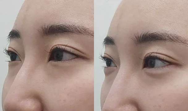 아띠에르 애교 필러 1cc 전후 — 영종도점